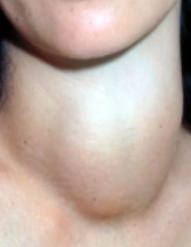 Thyroid Nodule